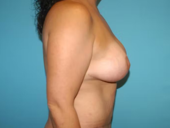 Mommy Makeover: Case 31 - After