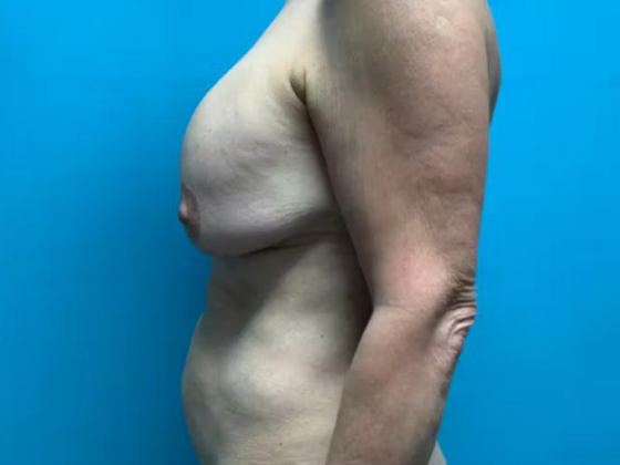 Mommy Makeover: Case 32 - Before