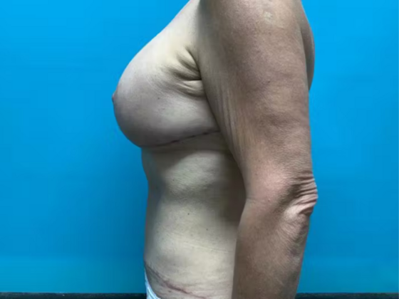 Mommy Makeover: Case 32 - After