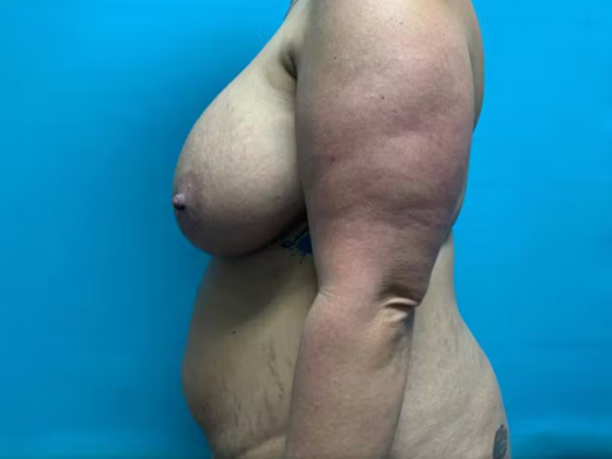 Mommy Makeover: Case 34 - Before