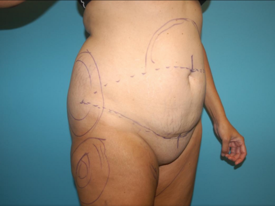 Mommy Makeover: Case 35 - Before