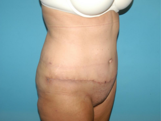 Mommy Makeover: Case 35 - After