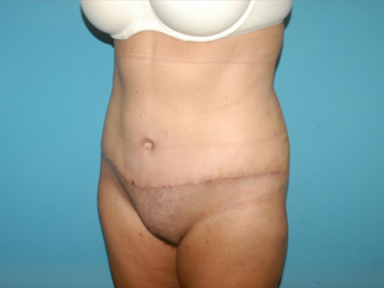 Mommy Makeover: Case 35 - After