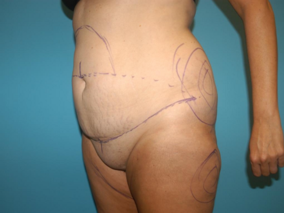 Mommy Makeover: Case 35 - Before