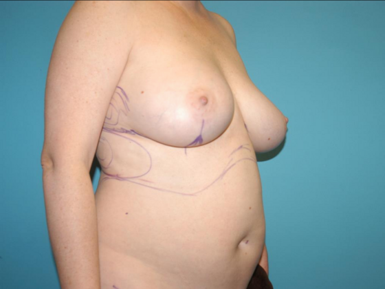 Mommy Makeover: Case 36 - Before