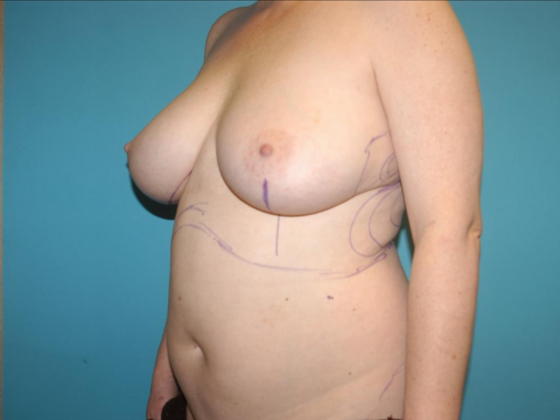 Mommy Makeover: Case 36 - Before