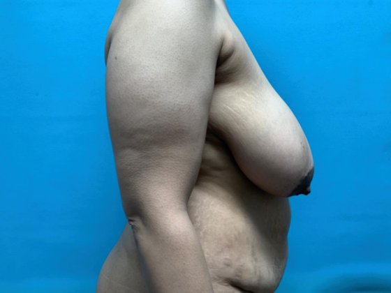 Mommy Makeover: Case 37 - Before