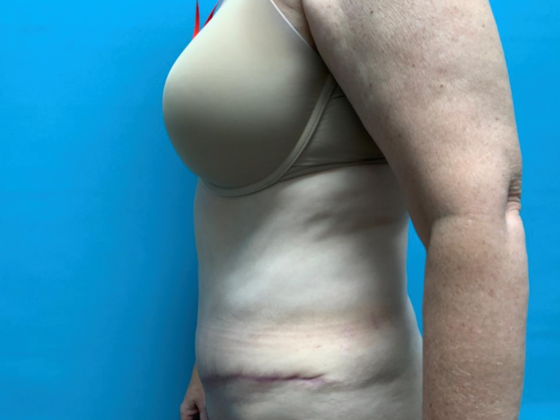 Mommy Makeover: Case 38 - After