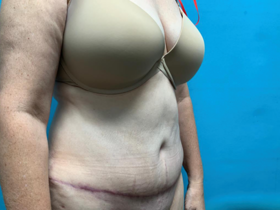 Mommy Makeover: Case 38 - After