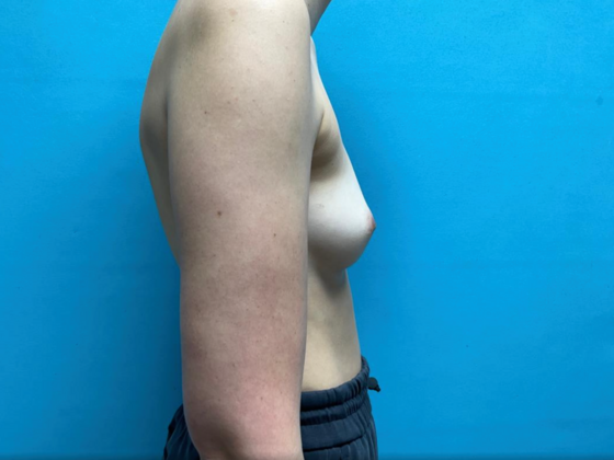 Breast Augmentation: Case 27 - Before