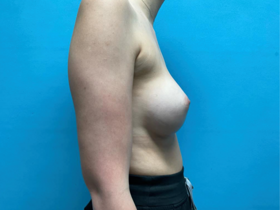 Breast Augmentation: Case 27 - After