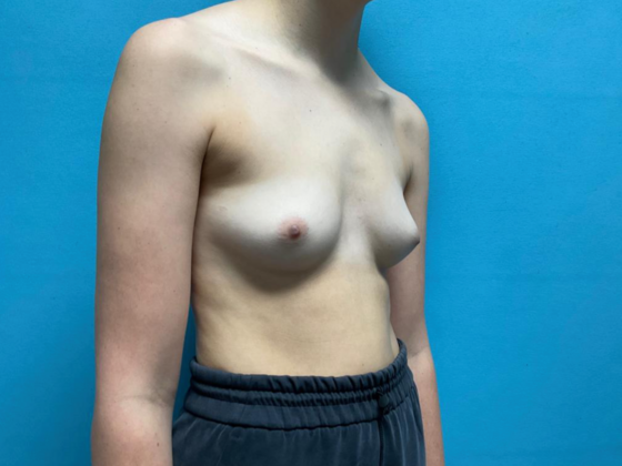 Breast Augmentation: Case 27 - Before