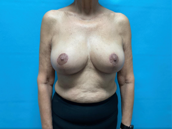 Breast Reduction Case 11 - After
