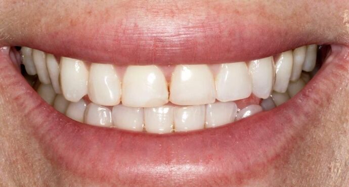 Smile Makeover & Veneers: Shannon - Before