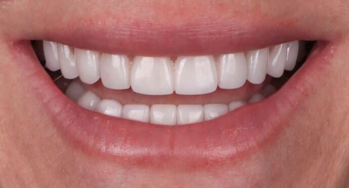 Smile Makeover & Veneers: Shannon - After