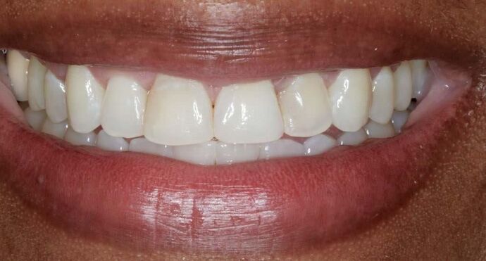 Smile Makeover & Veneers: Rahisha - Before