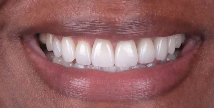 Smile Makeover & Veneers: Rahisha - After