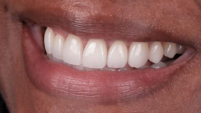 Smile Makeover & Veneers: Rahisha - After