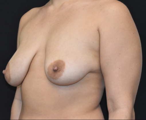 Mastopexy: Case 7 - Before