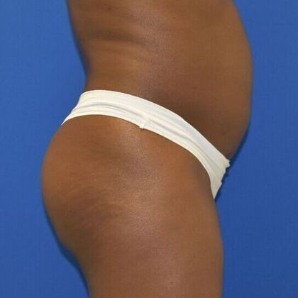 Brazilian Butt Lift: Case 4 - Before