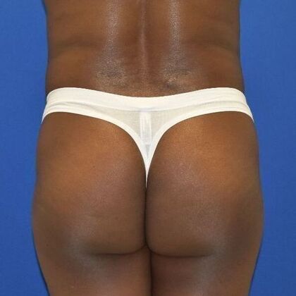 Brazilian Butt Lift Case 4 - Before