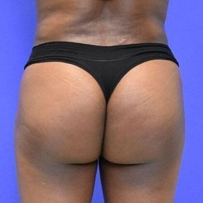 Brazilian Butt Lift Case 4 - After