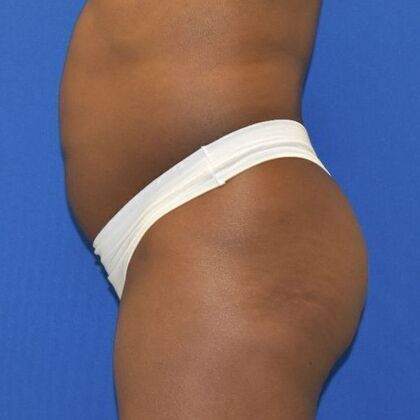 Brazilian Butt Lift: Case 4 - Before