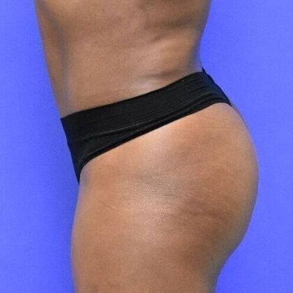 Brazilian Butt Lift: Case 4 - After