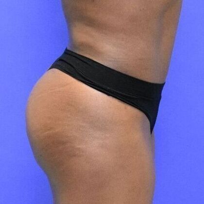 Brazilian Butt Lift: Case 4 - After