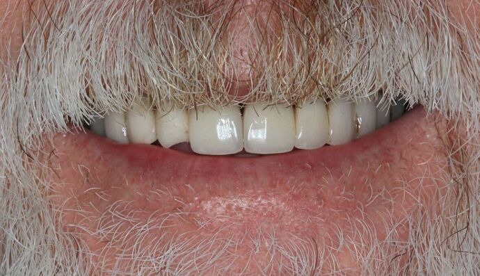 Full Mouth Reconstruction: Case 43 - Before