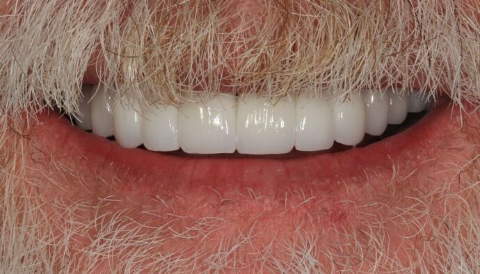 Full Mouth Reconstruction: Case 43 - After