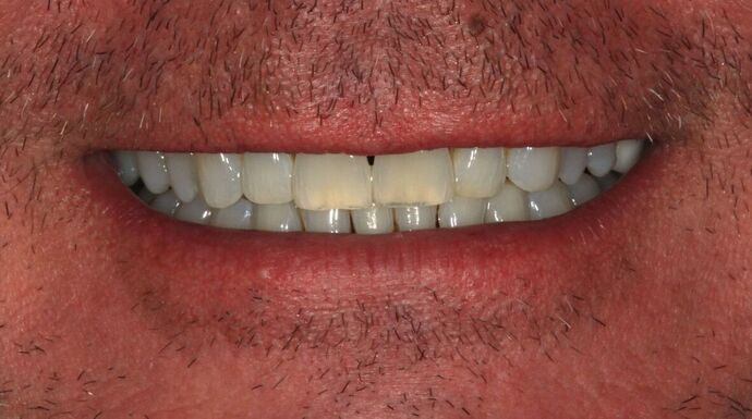 Porcelain Veneers Case 29 - Before