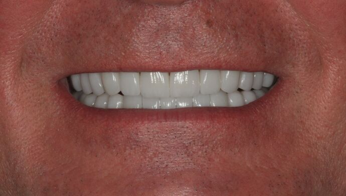 Porcelain Veneers Case 29 - After