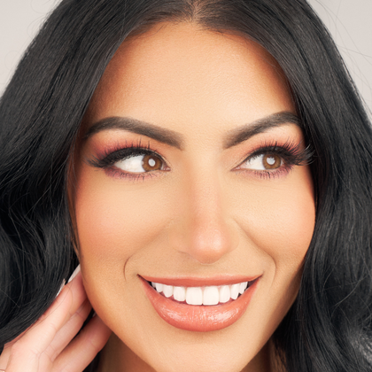 No Prep Porcelain Veneers Toni - After