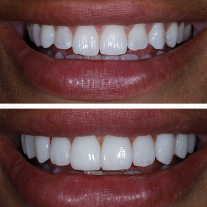 No Prep Porcelain Veneers Toni - Before