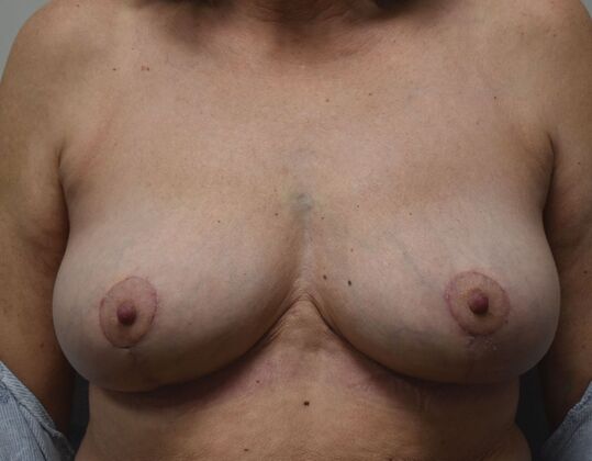Breast Implant Removal: Case 49 - After