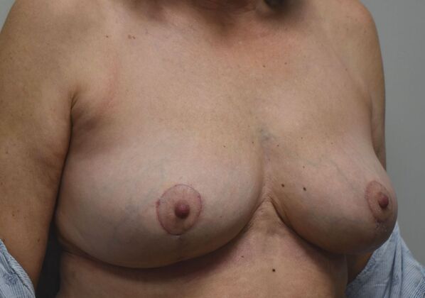 Breast Revision: Case 278 - After