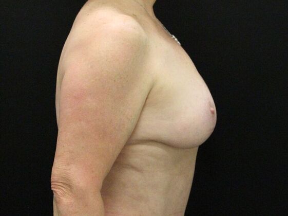 Breast Reduction & Lift: Case 19 - After
