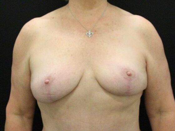 Breast Reduction & Lift Case 19 - After