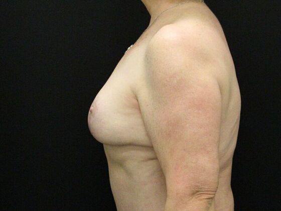 Breast Reduction & Lift: Case 19 - After