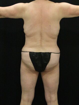 Liposuction Case 38 - After