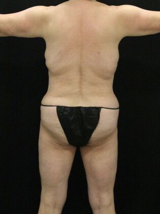 Tummy Tuck: Case 42 - After