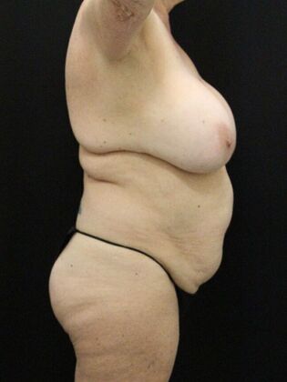 Tummy Tuck: Case 65 - Before
