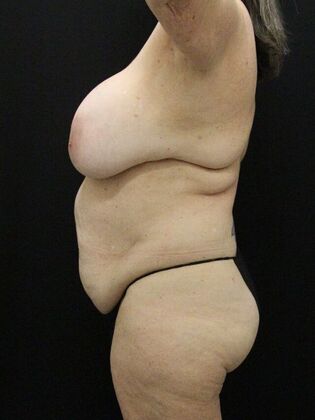 Tummy Tuck: Case 65 - Before