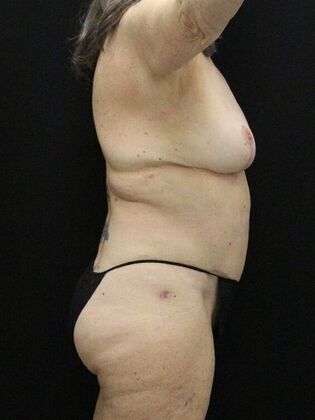 Tummy Tuck: Case 65 - After
