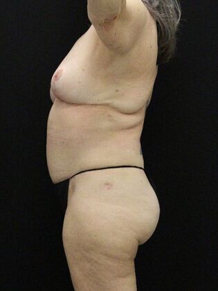 Tummy Tuck: Case 65 - After