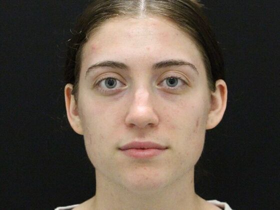 Rhinoplasty Case 4 - Before