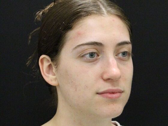 Rhinoplasty: Case 4 - Before