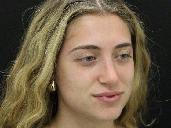 Rhinoplasty: Case 4 - After