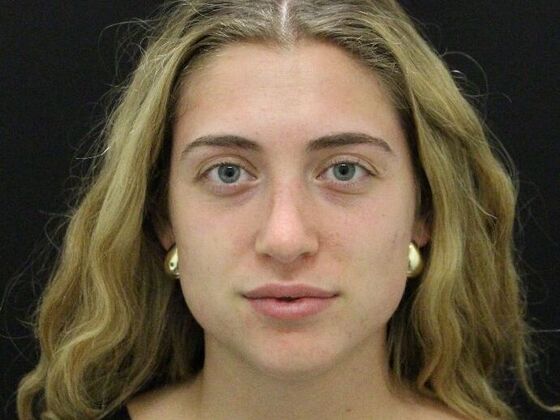 Rhinoplasty Case 4 - After